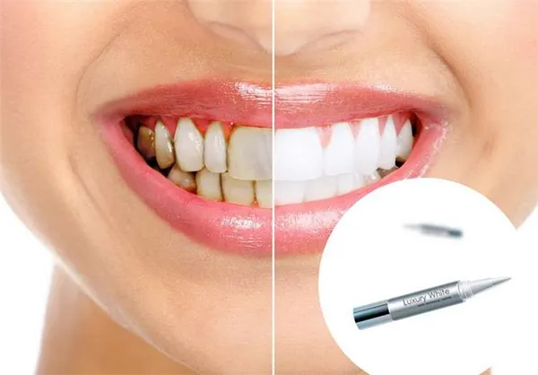 Карандаш для отбеливания зубов: правила выбора и использования 2