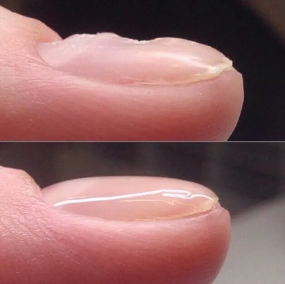 Причинами деформации ногтя могут быть как внутренние, так и внешние факторы