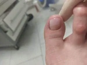 Показания для протезирования ногтя