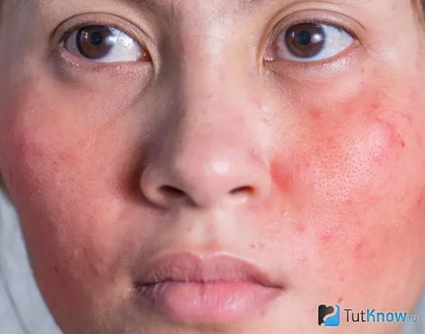 Аллергия на корейскую тканевую маску