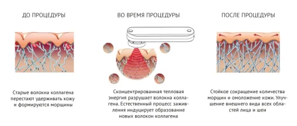 Маска миостимулятор для лица Biolift iFace, Gezatone