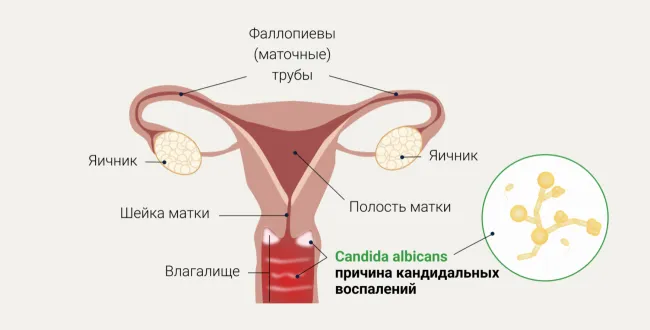 Молочница